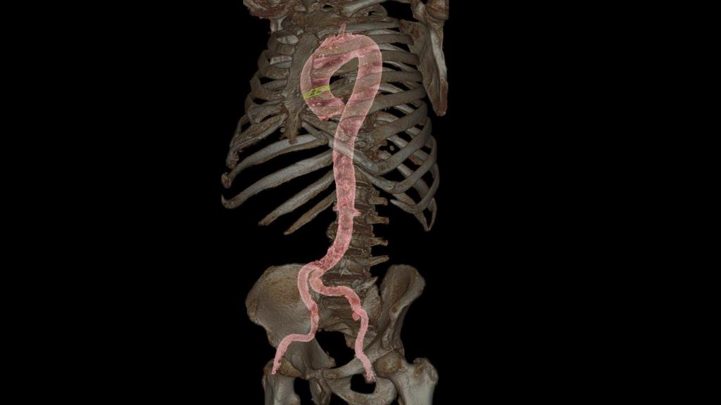 Imagen de un TAC realizado antes de la implantación de una válvula aórtica a través de catéter.