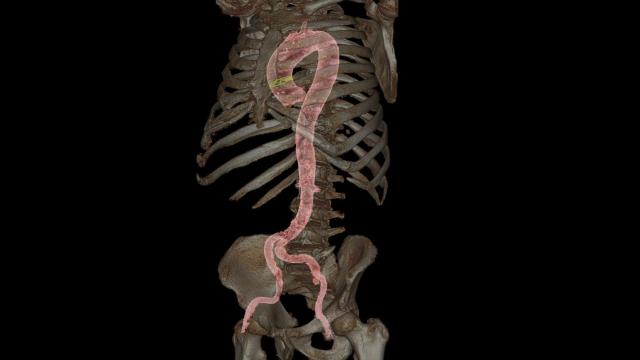 Imagen de un TAC realizado antes de la implantación de una válvula aórtica a través de catéter.