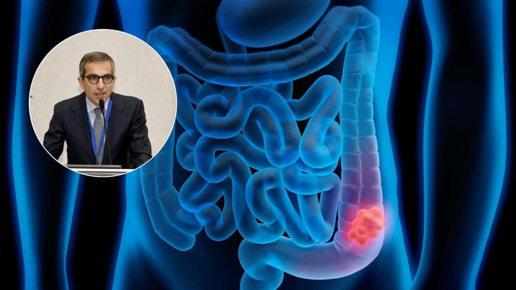Ilustración 3D de un cáncer de colon y el oncólogo Roberto Persiani.