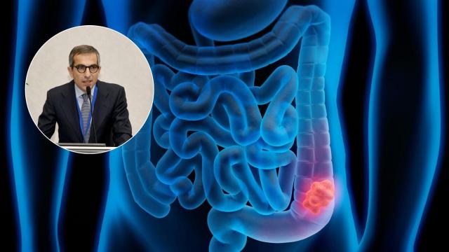 Ilustración 3D de un cáncer de colon y el oncólogo Roberto Persiani.