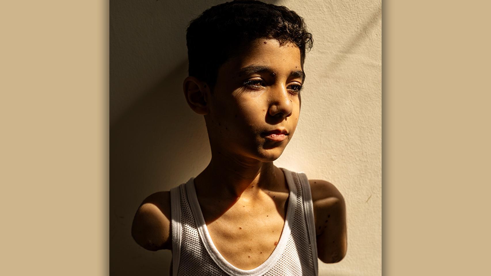 Mahmoud Ajjour, nueve años. Foto: Samar Abu Elouf, para The New York Times (detalle). Fotografía ganadora del World Press Photo 2025