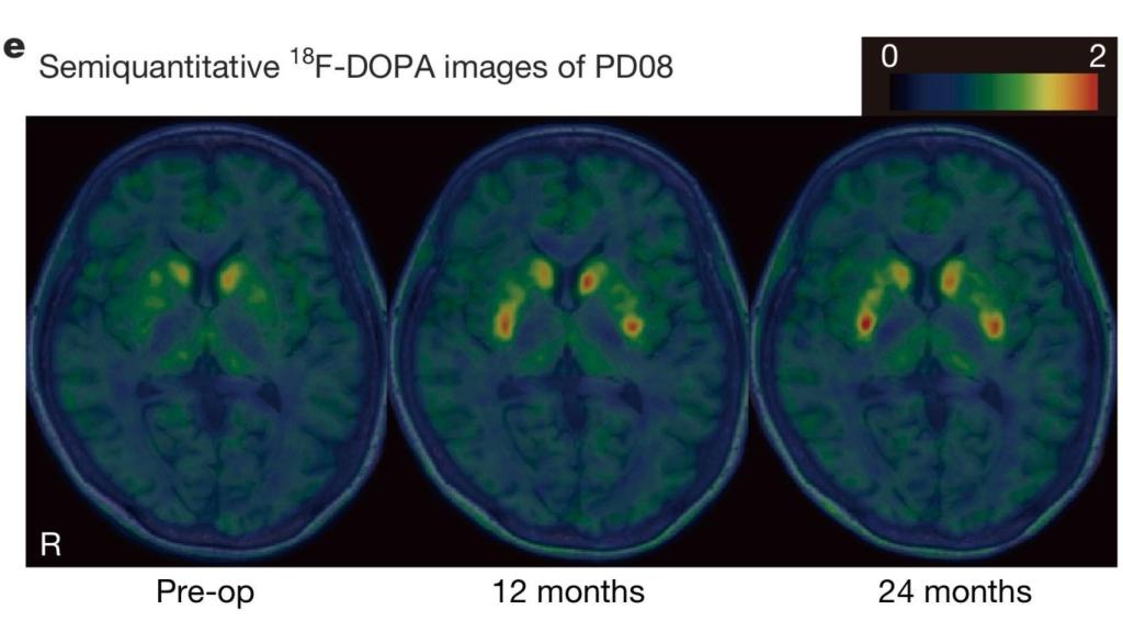 El escáner cerebral muestra el incremento de la actividad en las regiones implantadas con células madre.