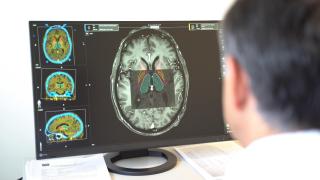 Escáner cerebral de un paciente con párkinson.