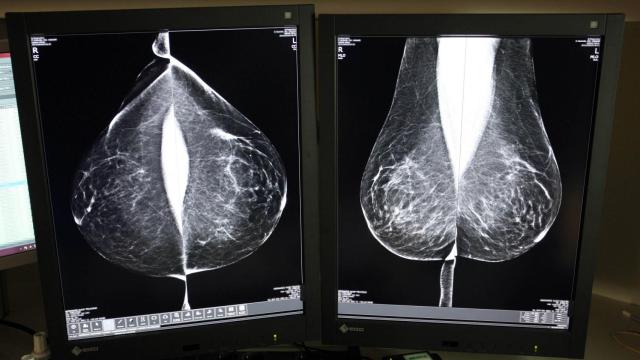 Una mamografía en el Hospital Río Hortega de Valladolid