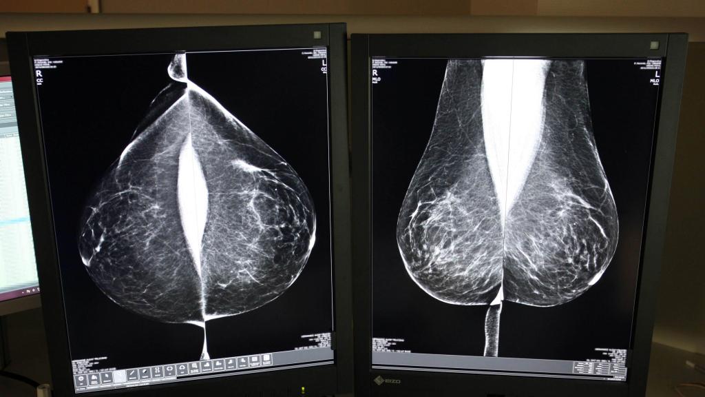 Una mamografía en el Hospital Río Hortega de Valladolid