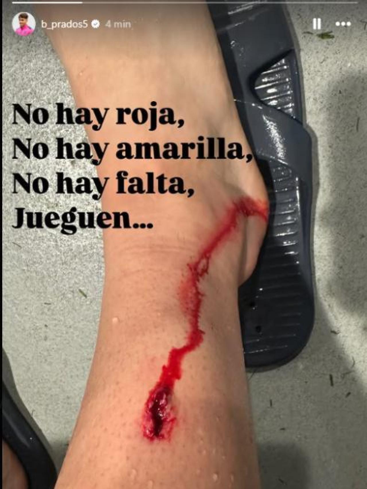 La tibia de Beñat Prados.