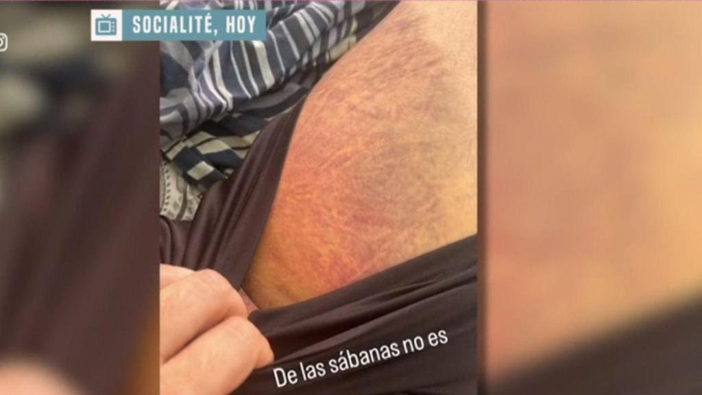 Imagen del hematoma de Andy compartida en sus redes sociales.