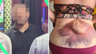 Un supuesto 'portero de la droga' de Benidorm y las heridas de Emily Bridge, una de las turistas agredidas.