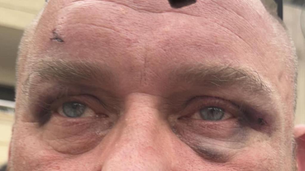 Las lesiones del marido de Tegan Didlock.