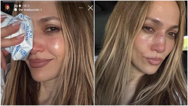 ¿Peligra el concierto de Jennifer López de Pontevedra? La cantante se rompe la nariz