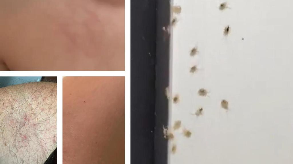 Algunas ronchas y los insectos.