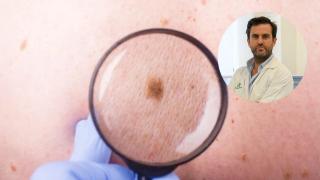 Un lunar y el dermatólogo Enrique Herrera en un montaje.