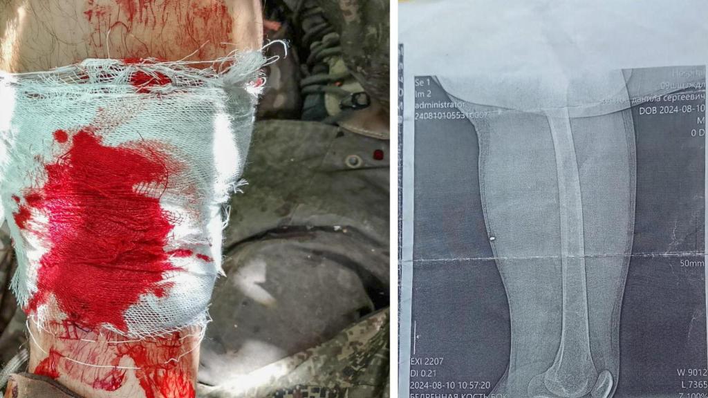 Una de las heridas sufridas por el sargento.