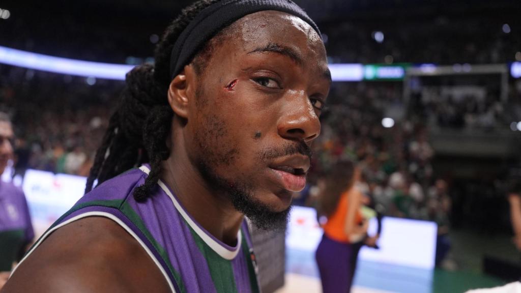 Así quedó la cara de Kendrick Perry tras el codazo de Musa