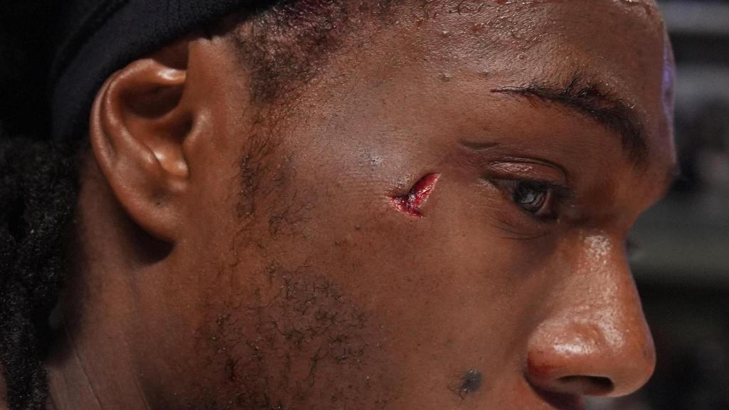 Así quedó la cara de Kendrick Perry tras el codazo de Musa