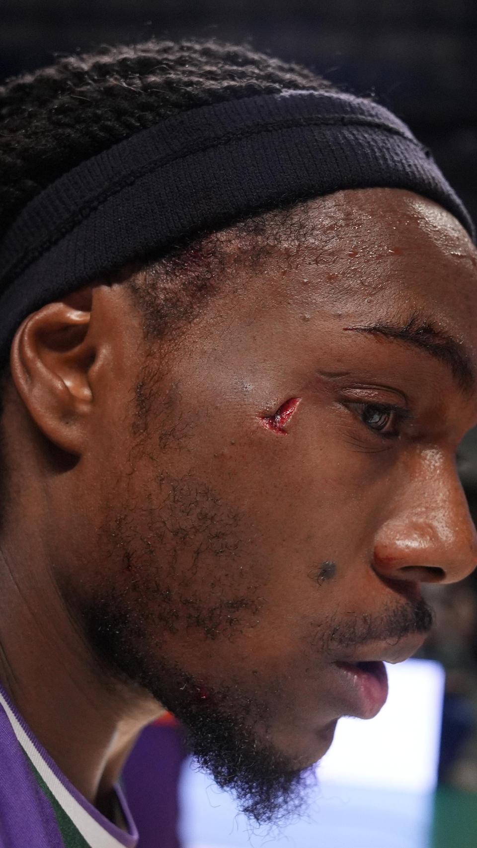 Así quedó la cara de Kendrick Perry tras el codazo de Musa