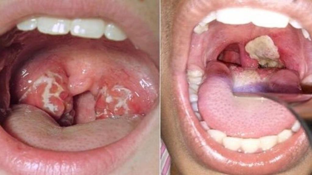 Imagen de la garganta de dos pacientes con síntomas de difteria.