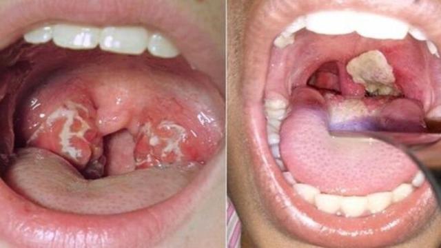 Imagen de la garganta de dos pacientes con síntomas de difteria.