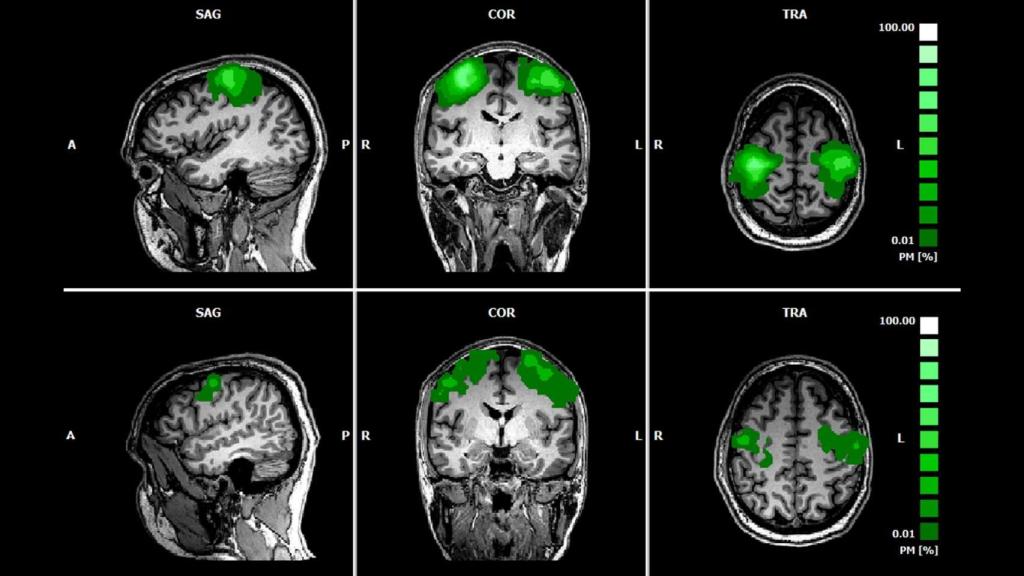 Imágenes de un escáner cerebral usando espectroscopia funcional de infrarrojo cercano