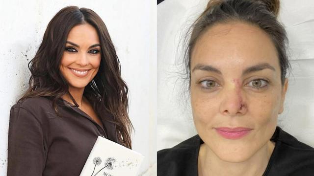 Mónica Carrillo muestra las secuelas de su cáncer de piel.