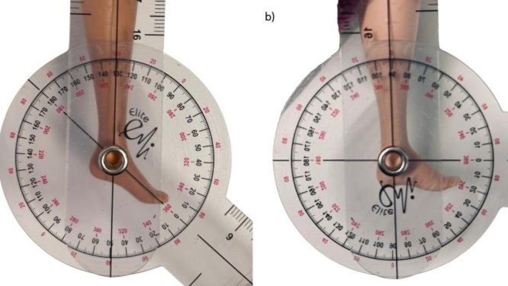 El grupo de podólogos de la Universidad de Monash (Melbourne) midió con un goniómetro la inclinación de las plantas de las Barbies.