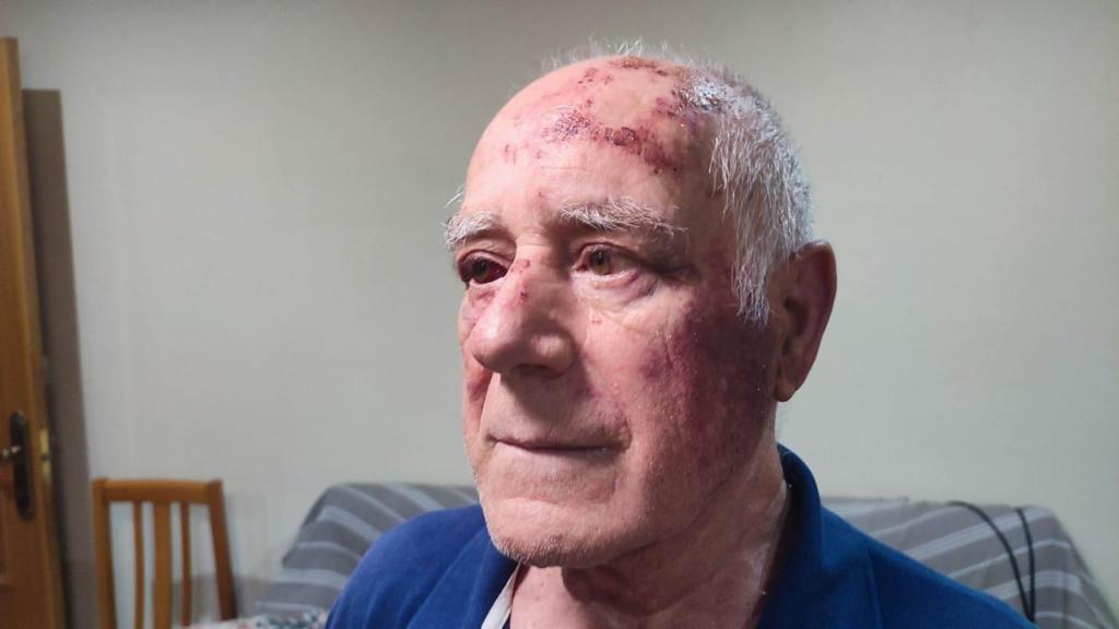 El rostro de Domingo está amoratado.