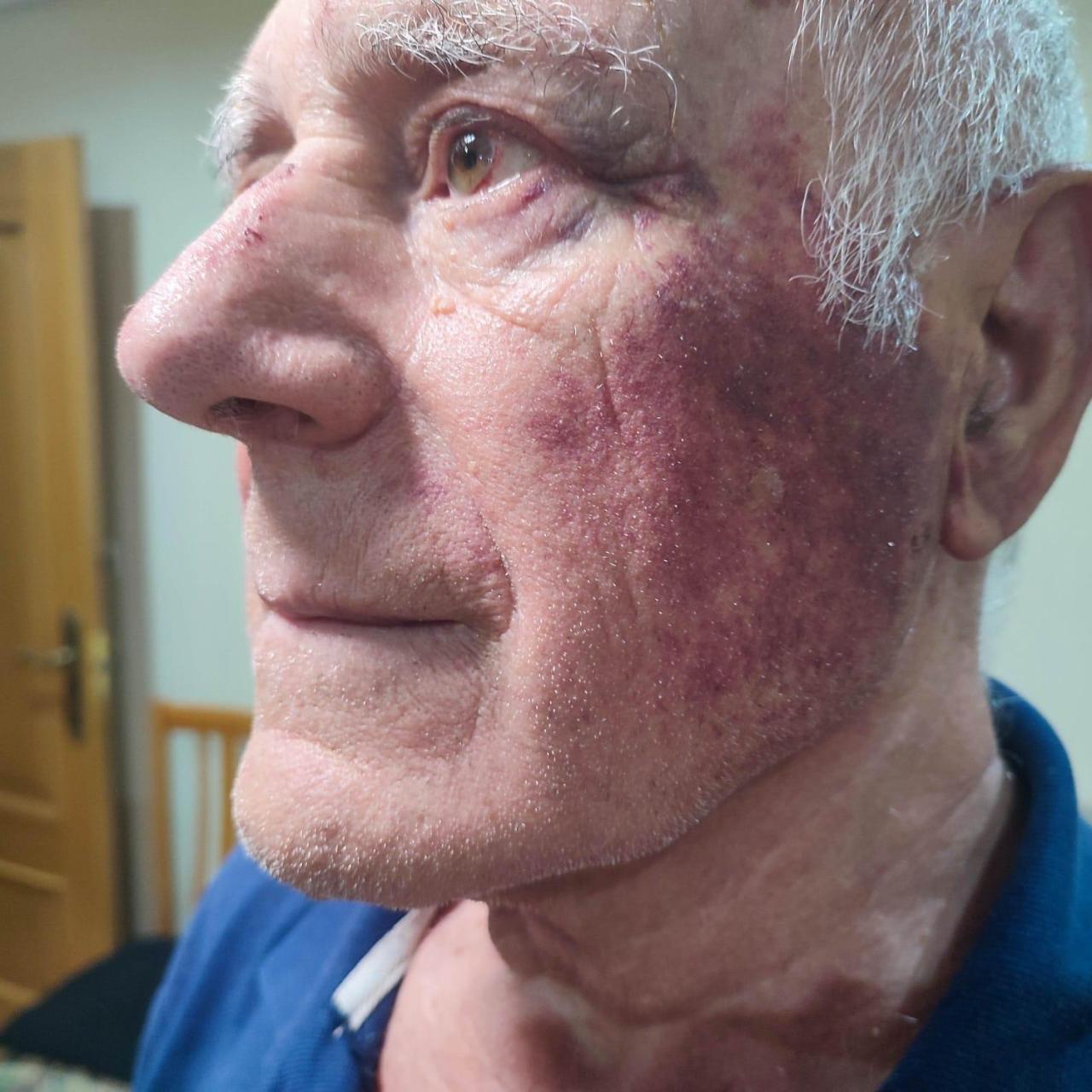 Domingo tiene inflamado el rostro por la agresión.