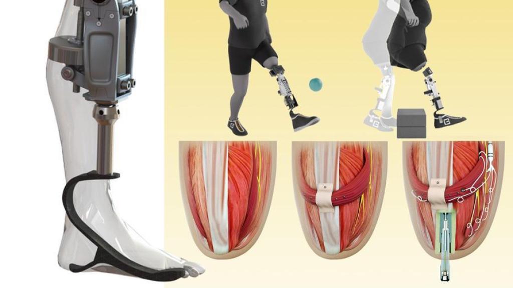 Implante unido a la prótesis robótica y las conexiones AMI