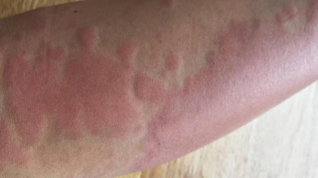 El brazo de Mari Carmen, tras la picadura del abejorro.