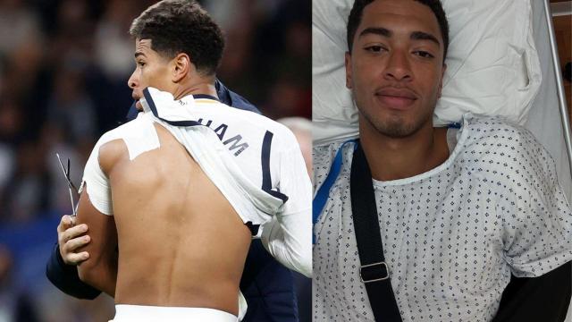 Jude Bellingham vendado y tras su operación.