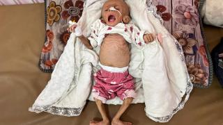 Zainab Abu Haleeb, una niña palestina de cinco meses diagnosticada con desnutrición, recibe tratamiento en el hospital Nasser en Jan Yunis, en el sur de la Franja de Gaza.