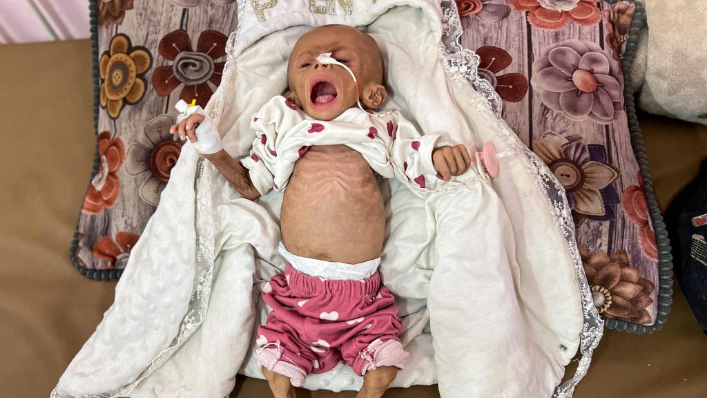 Zainab Abu Haleeb, una niña palestina de cinco meses diagnosticada con desnutrición, recibe tratamiento en el hospital Nasser en Jan Yunis, en el sur de la Franja de Gaza.