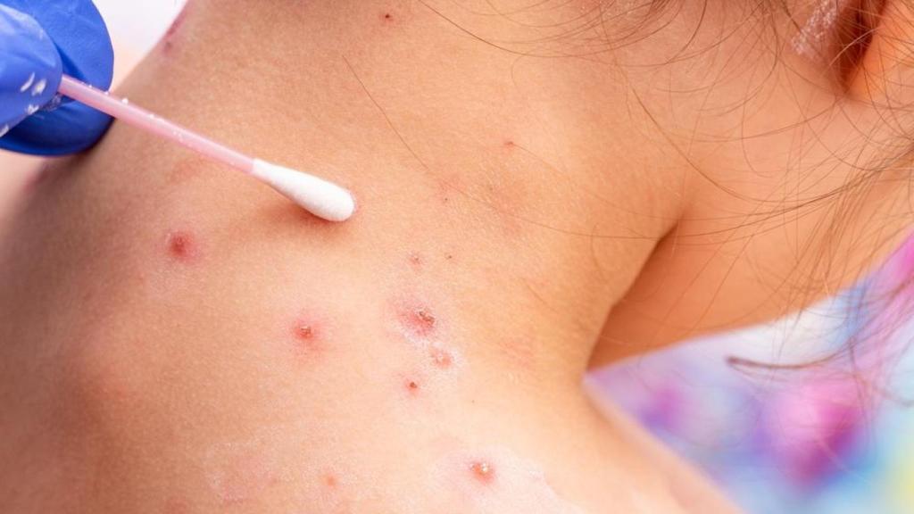 Efectos de la viruela del mono.