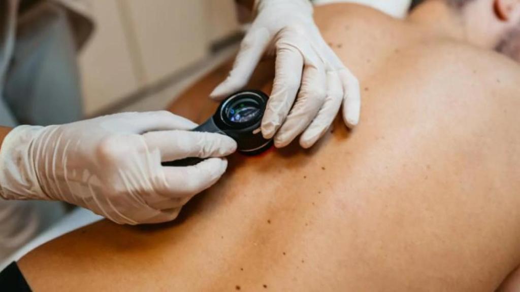 Imagen de un dermatólogo revisando lunares.