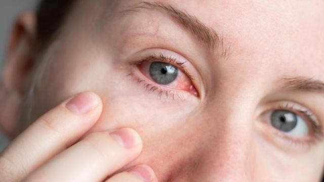 Mujer con una infección en el ojo