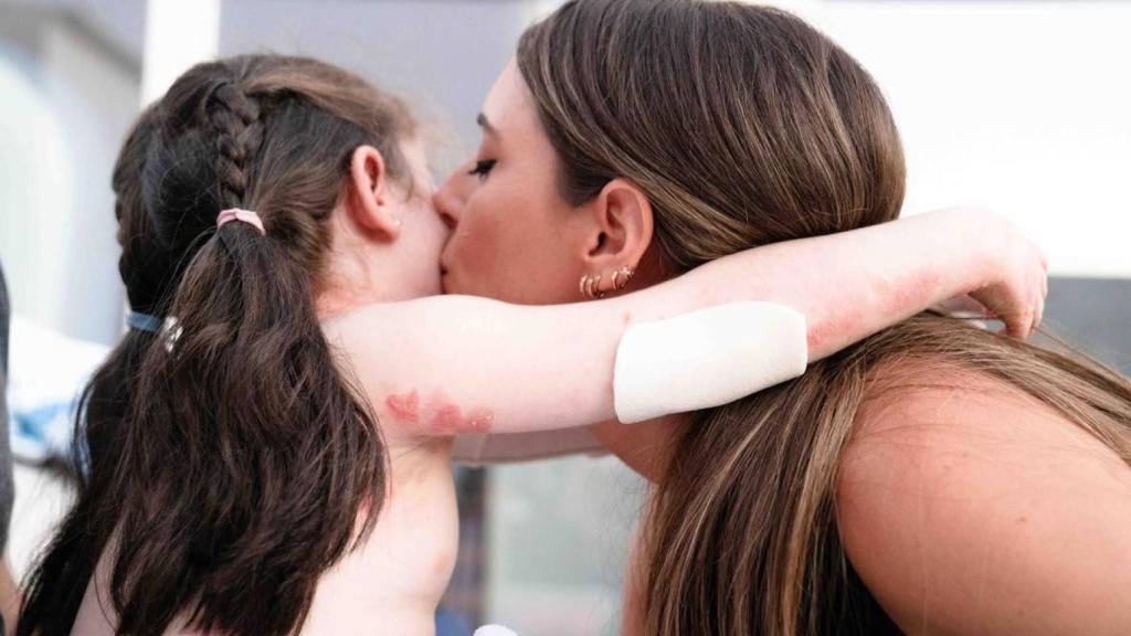 Una niña con la enfermedad de Piel de Mariposa, besada por su madre.