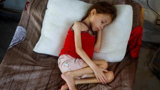 Una niña palestina con malnutrición.