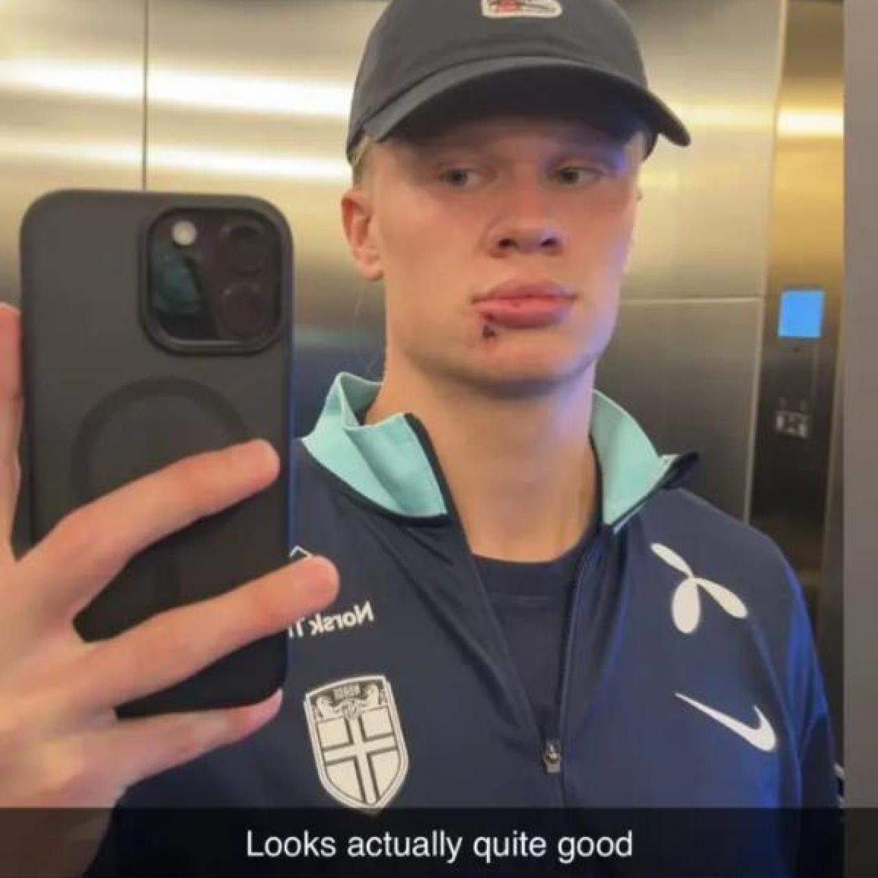 Haaland muestra su herida en la boca.