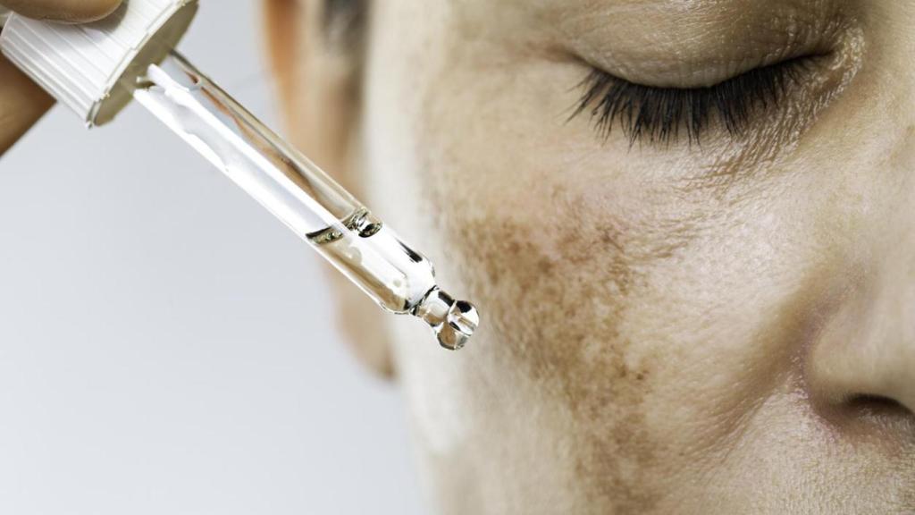 Imagen de archivo que muestra el aspecto de los léntigos.