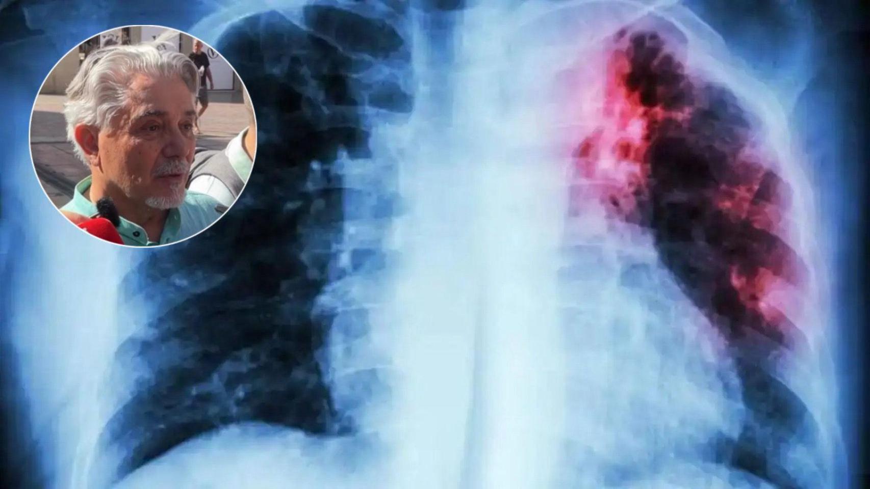 Montaje de una radiografía de cáncer de pulmón y Rafael.