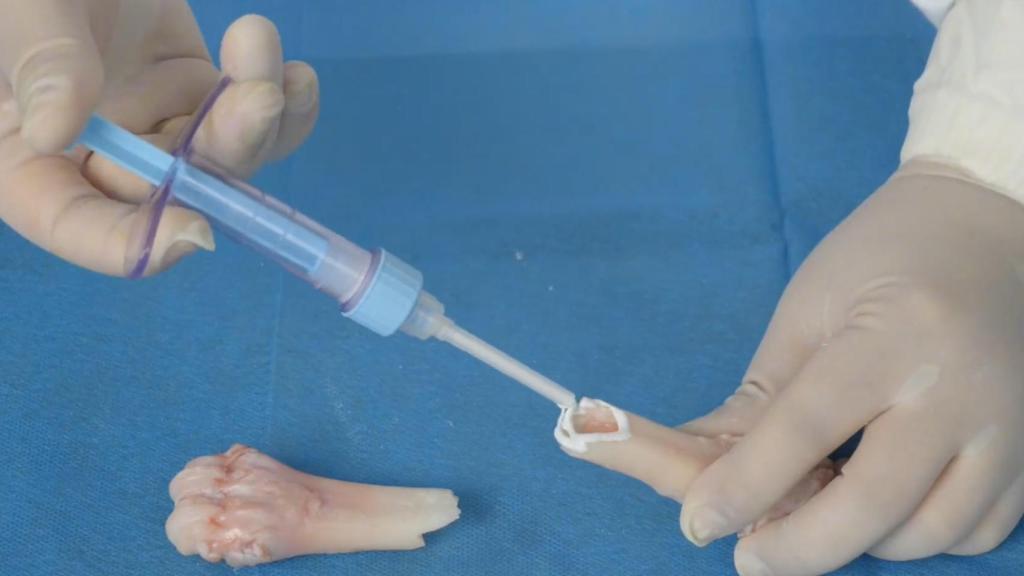 Un médico inyectado el biopegamento Bone 02 en un hueso.