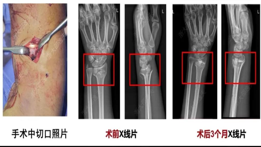 El biopegamento Bone 02 en un hueso.