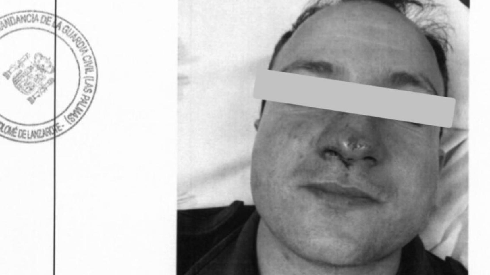 Vista de las lesiones de uno de los agentes.