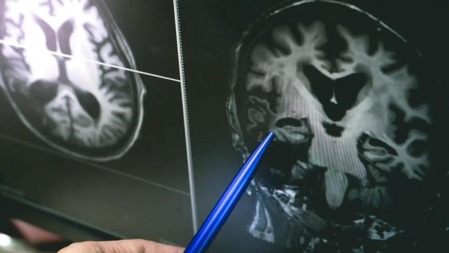 Imagen de archivo de un escáner cerebral.