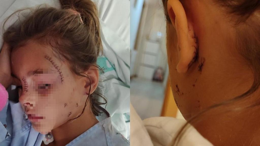 Imágenes cedidas por Ramona, madre de Prisicila, para demostrar la gravedad de los bocados que su hija sufrió en el rostro por el perro de una vecina.