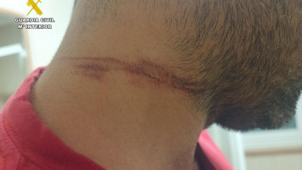 Imagen de las heridas que sufrió el motorista en el cuello en Anaya de Alba (Salamanca)