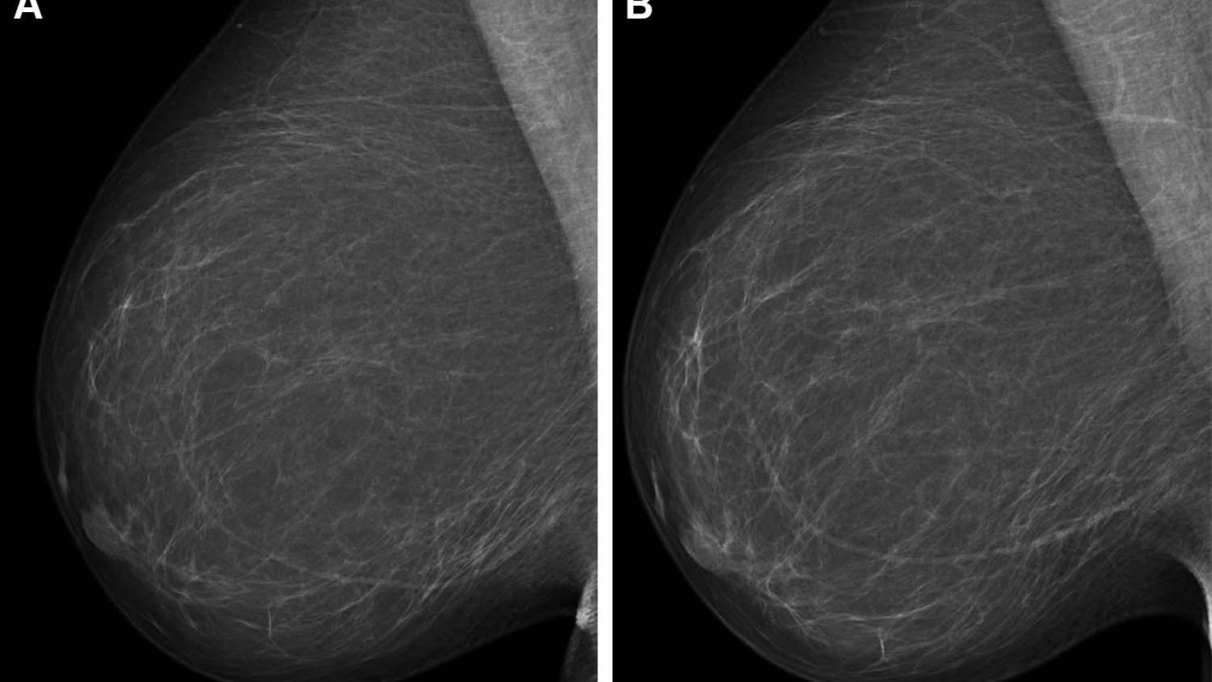 Mamografía en una imagen de archivo.