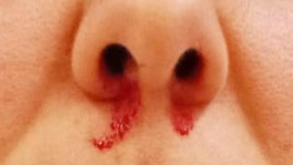 Sangrado nasal en trabajadoras de los laboratorios del Hospital de Toledo.