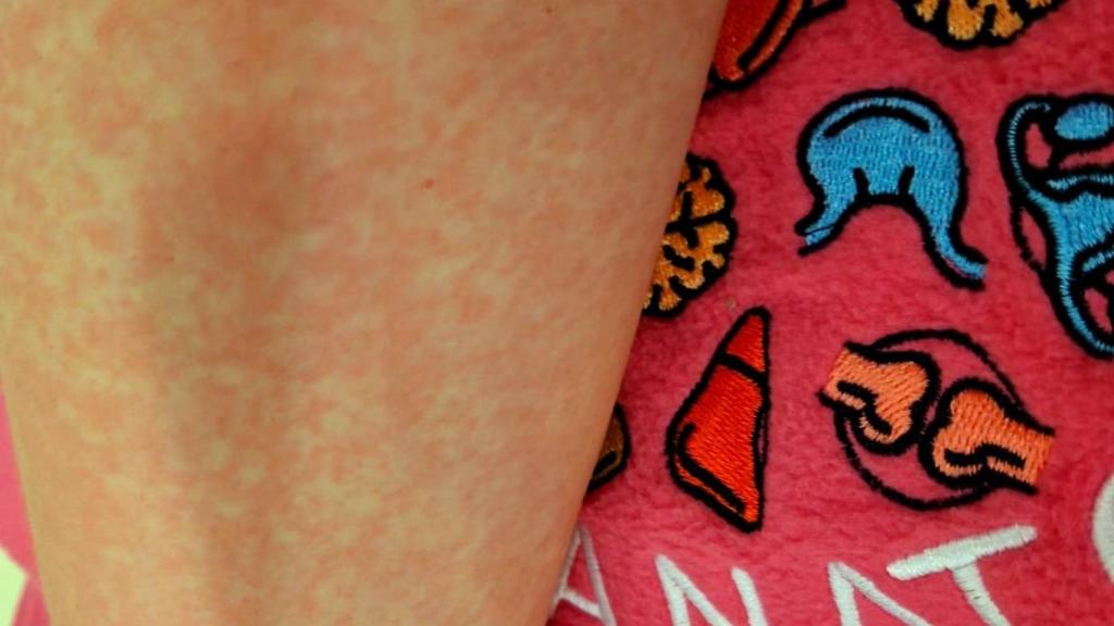 Brazo irritado de una de las trabajadoras del laboratorio del Hospital de Toledo.