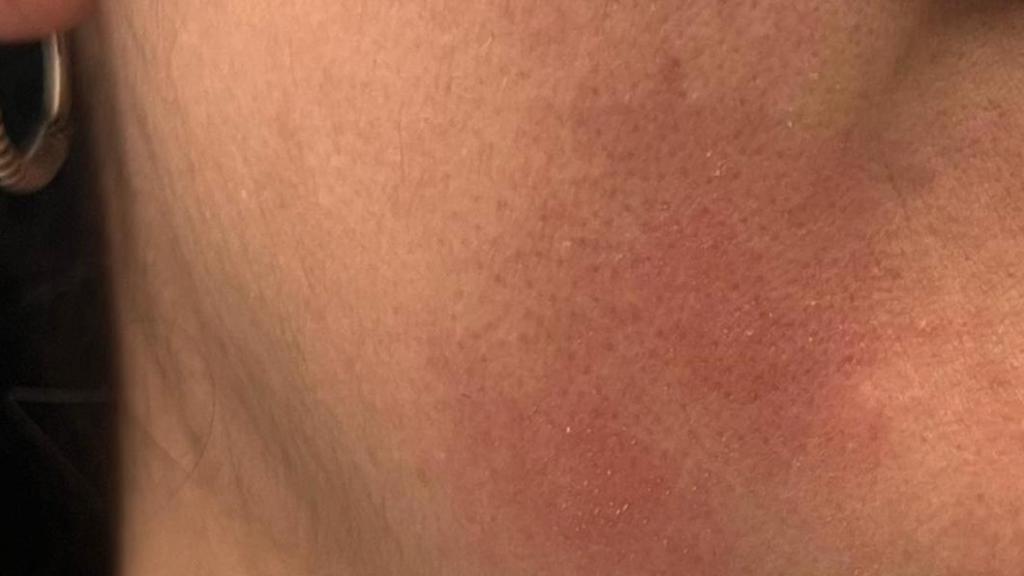 Mejilla irritado de una trabajadora.